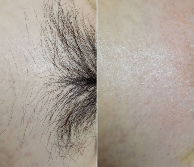 Triệt Lông Bikini Tại Sen Beauty